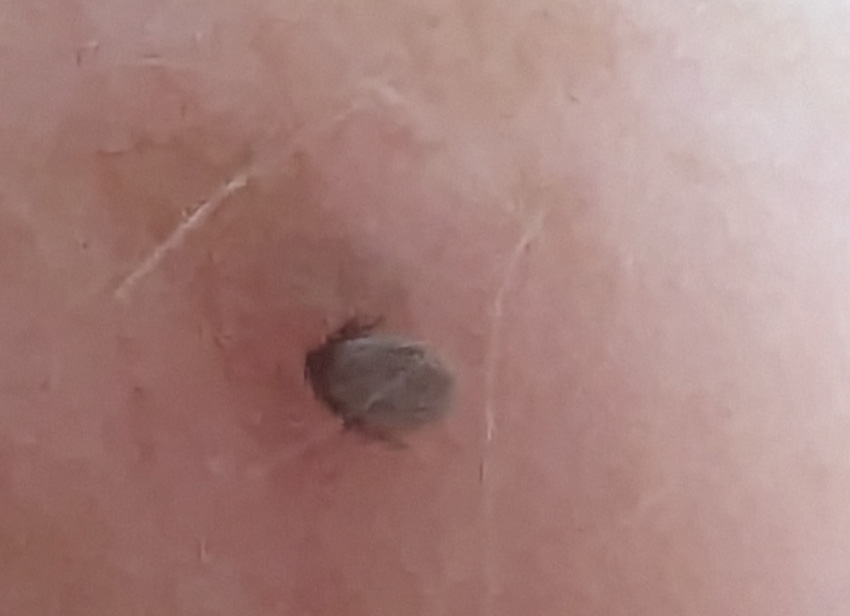 Lookout for Lyme Disease